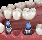 20142777_24.01.2022_Protezirovanie zubov na implantah_64662711.jpg