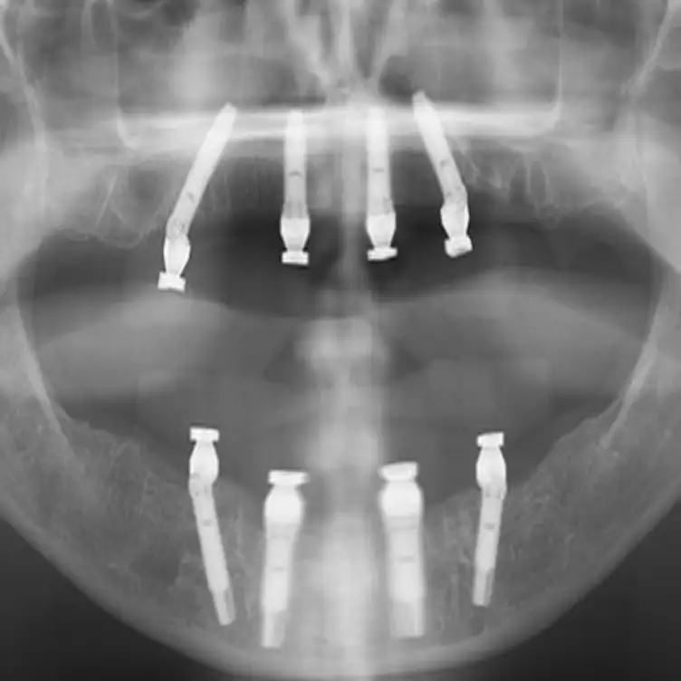 All-on-4 в Москве в клинике Стомос