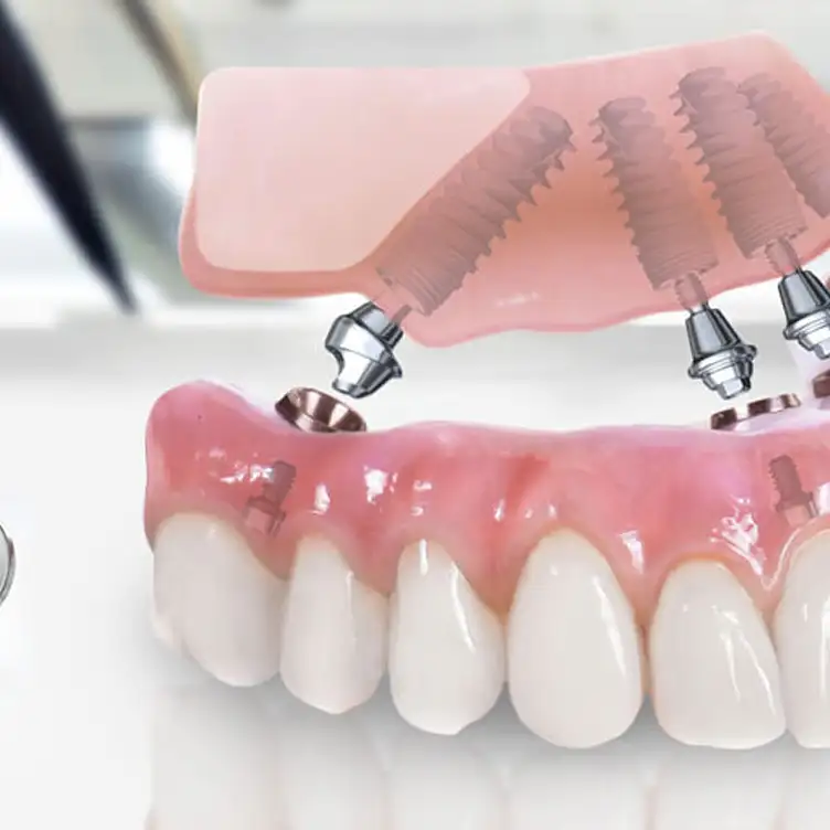 All-on-4 в Москве в клинике Стомос