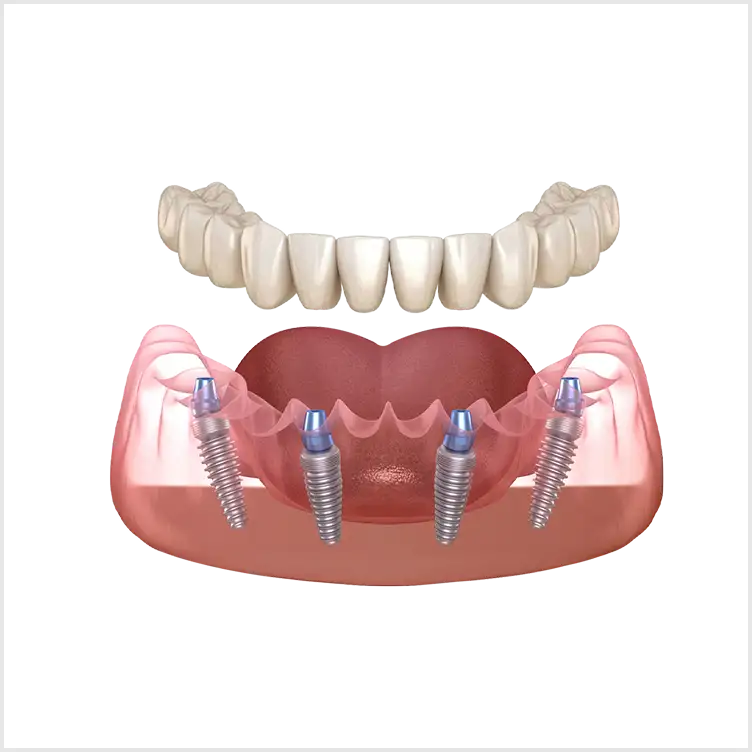 All-on-4 в Москве в клинике Стомос