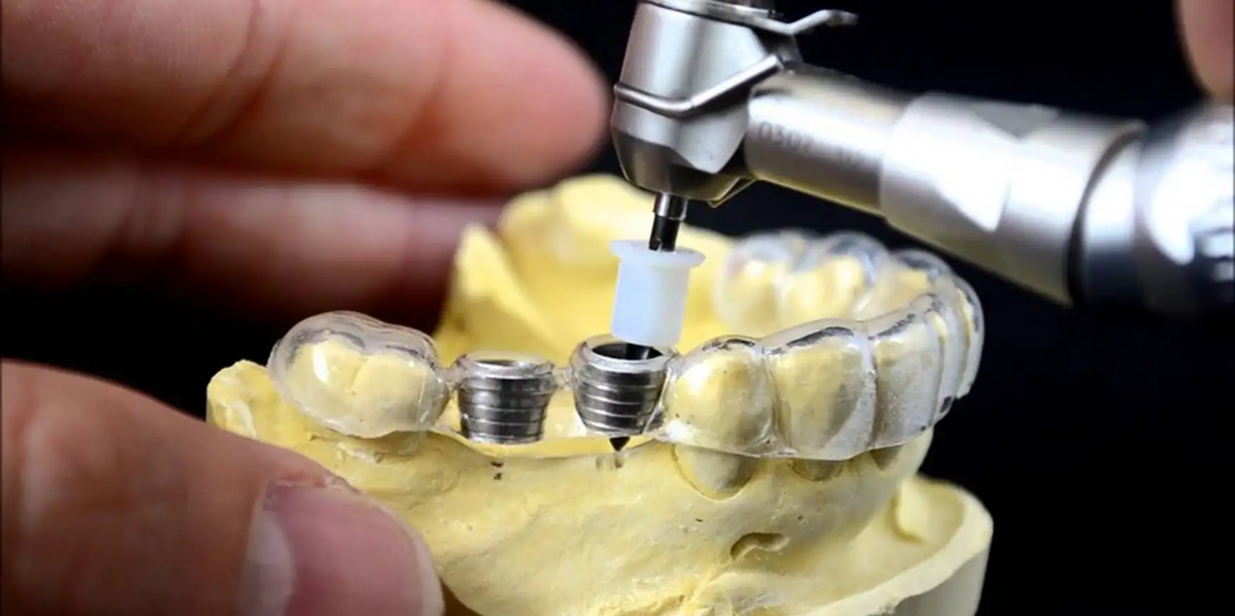 Хирургический шаблон при имплантации ALL-ON-4