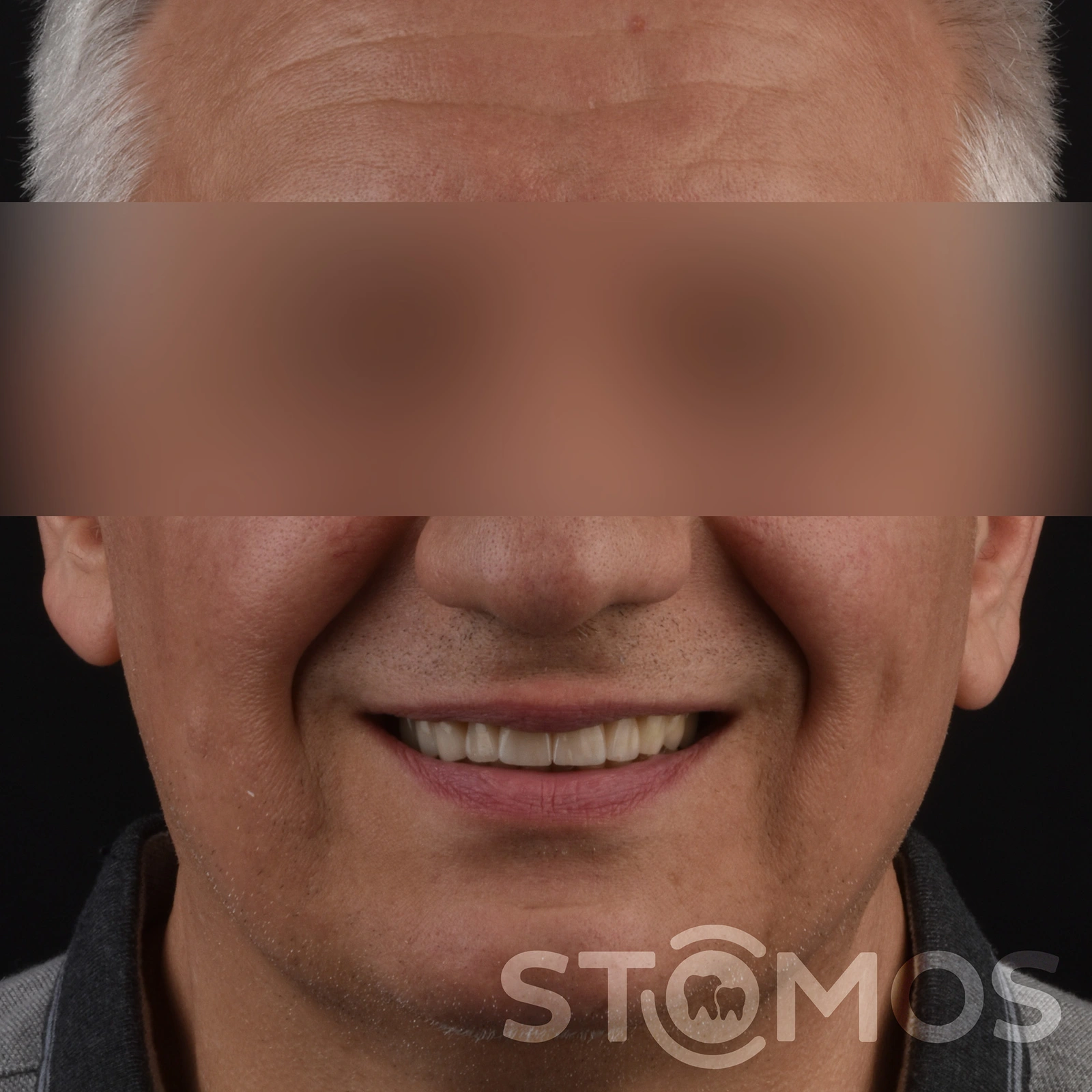 Имплантация all-on-4 в Москве