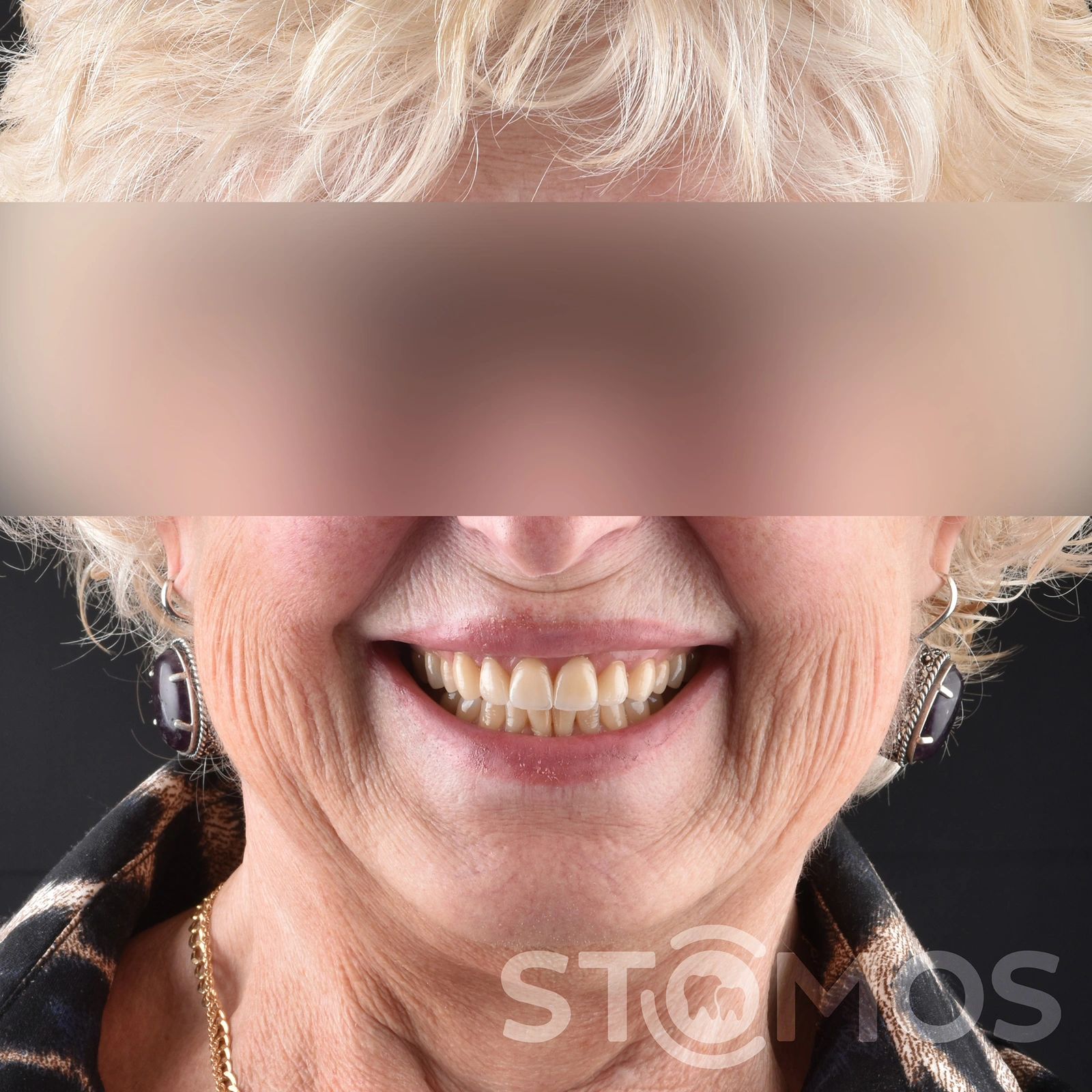 Имплантация all-on-4 в Москве