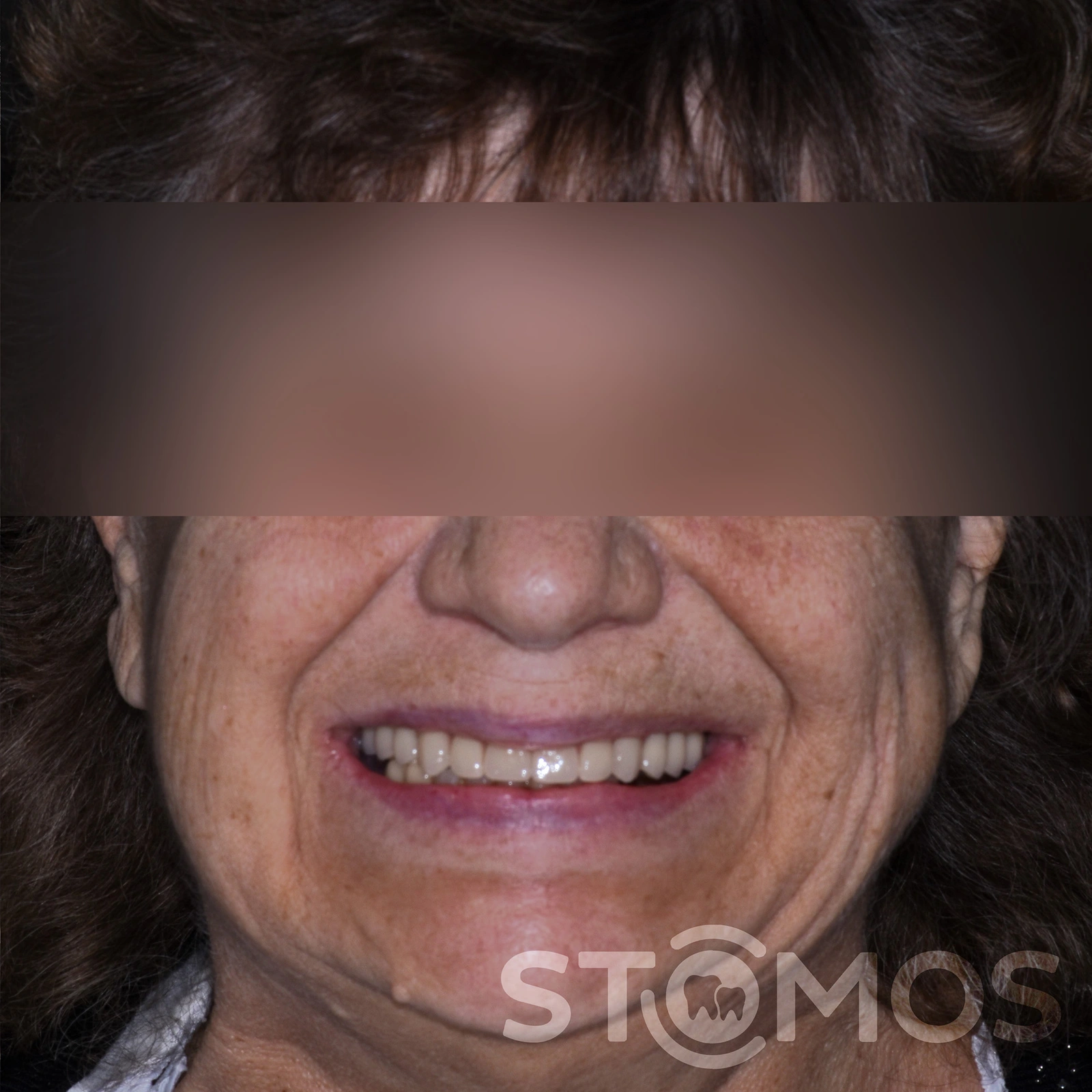 Имплантация all-on-4 в Москве