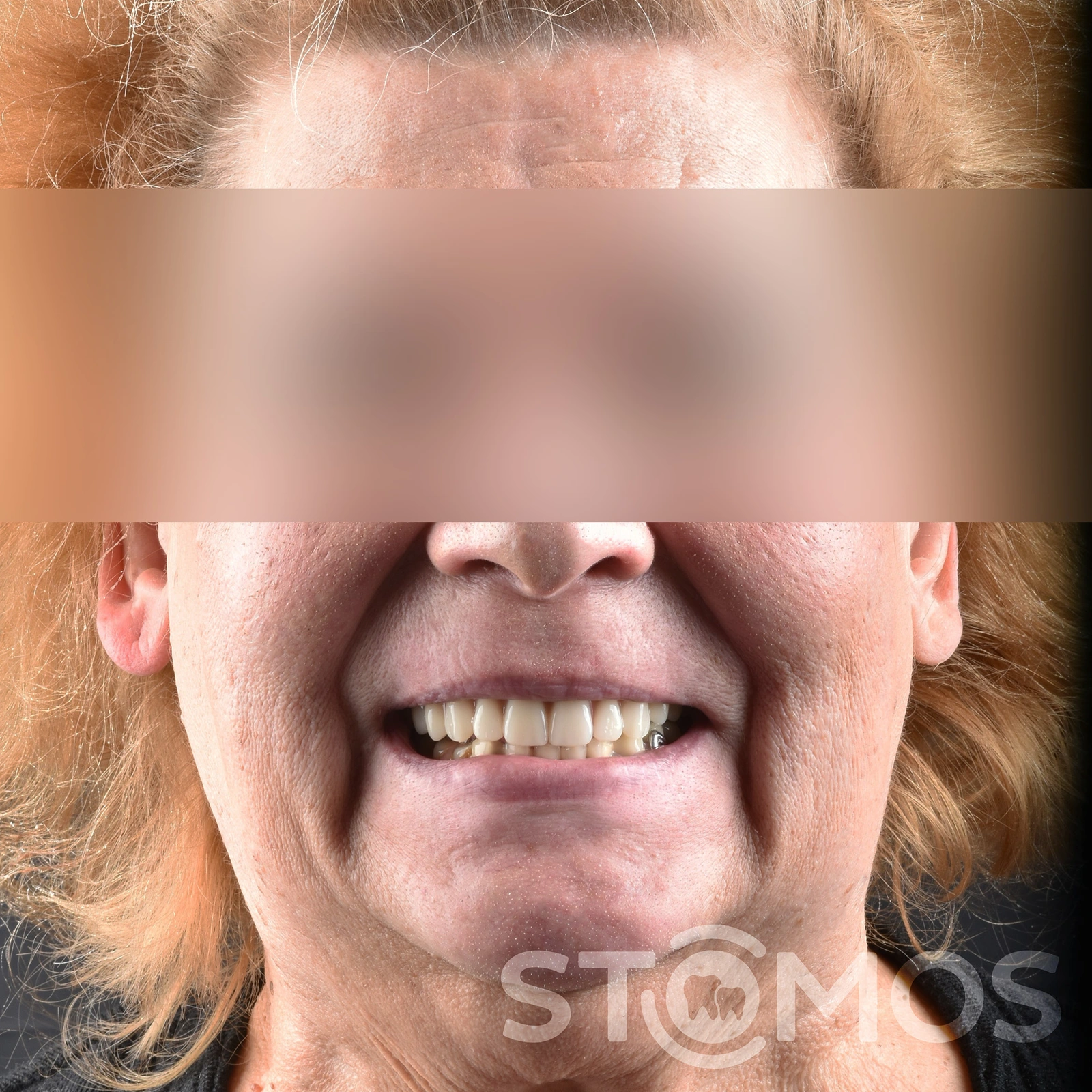 Имплантация all-on-4 в Москве