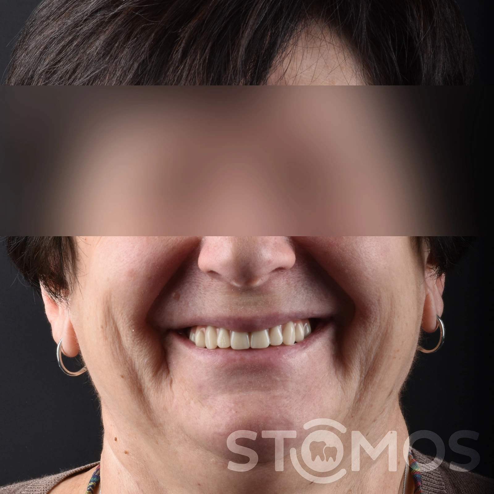 Имплантация all-on-4 в Москве