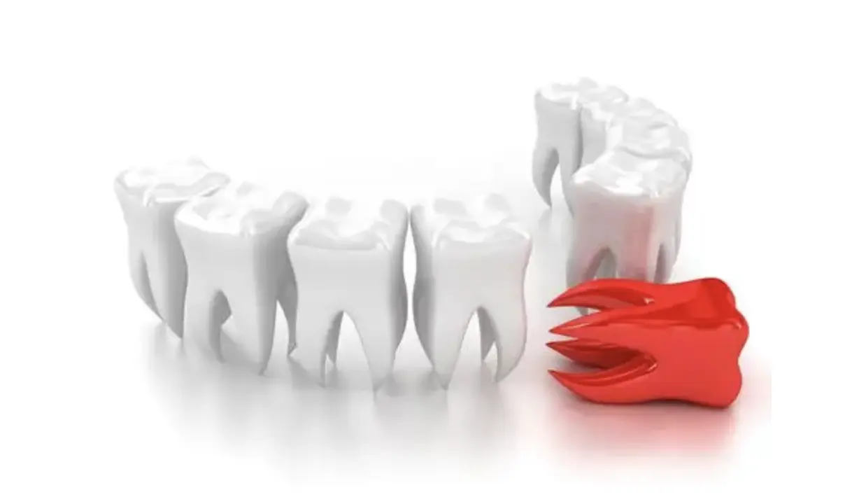 Удаление зуба