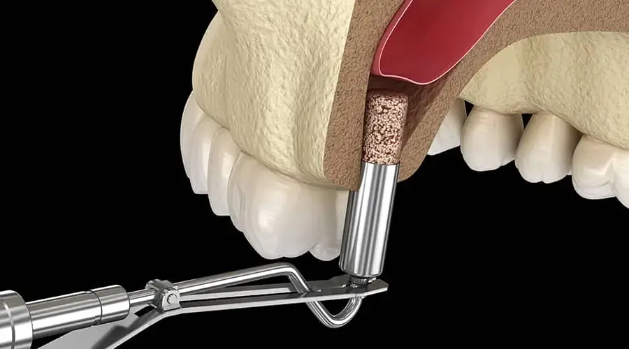 синус-лифтинг в клинике Стомос в Москве