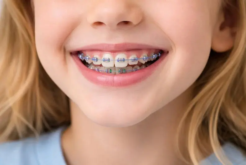 Брекеты детские