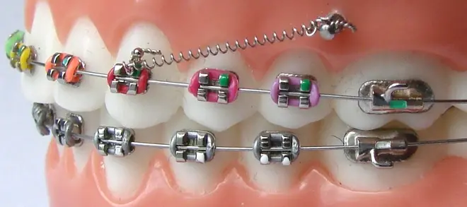 Микроимпланты