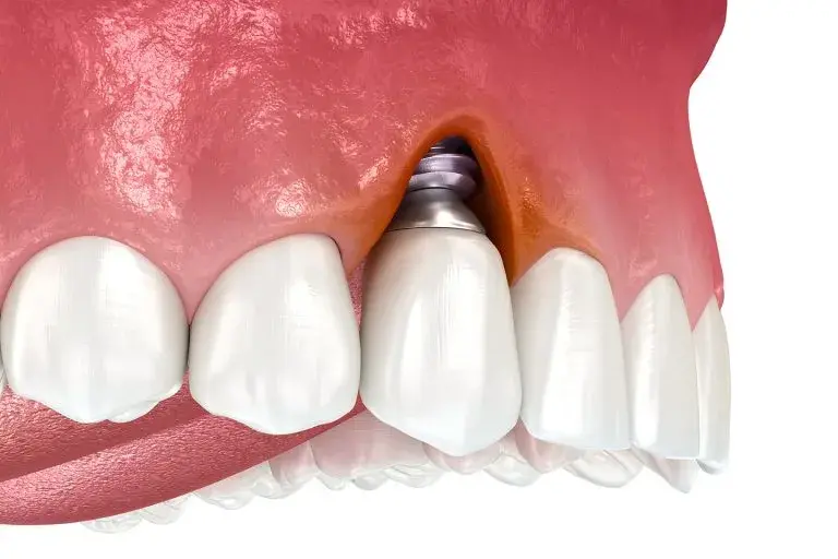 Периимплантит