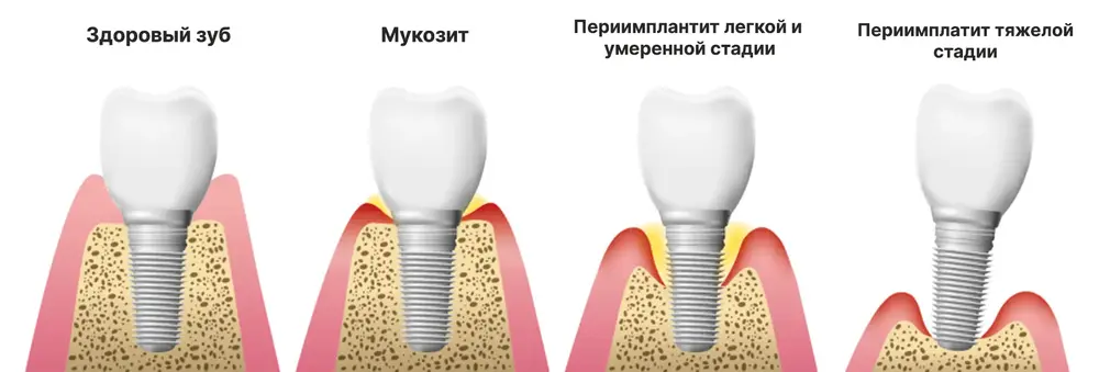 Стадии развития периимплантита