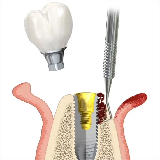 Хирургическое лечение периимплантита
