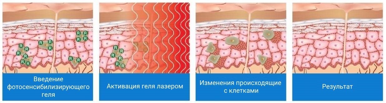 Фотодинамическая терапия зно презентация